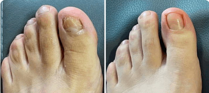 What is Orivelle Nail Fungus Pen – Orievelle