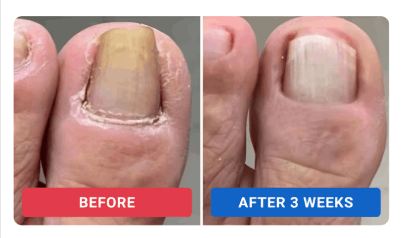 Orivelle Nail Fungus Pen review by Dan R. – Orievelle