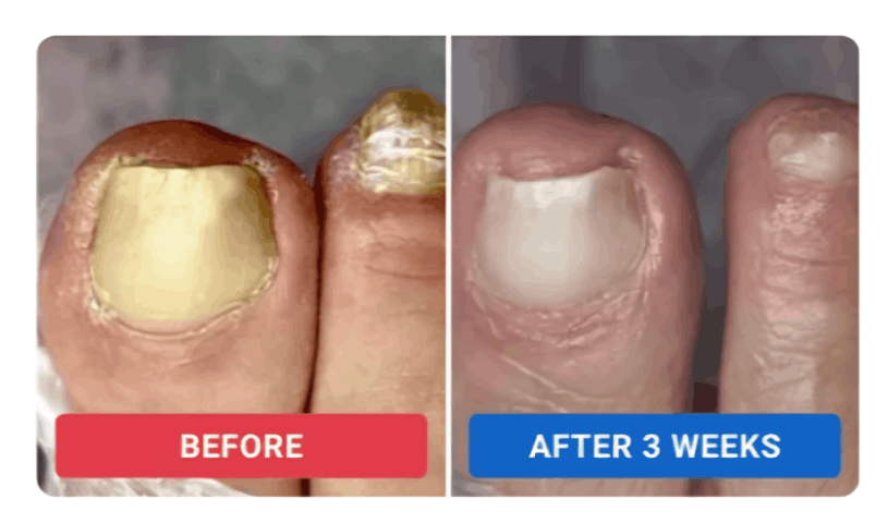 Orivelle Nail Fungus Pen review by Elena S. – Orievelle