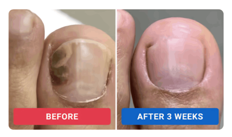 Orivelle Nail Fungus Pen review by Rachel M. – Orievelle
