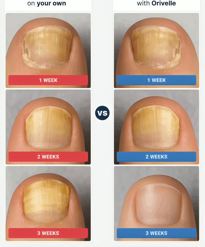 Orivelle Nail Fungus Pen before and after – Orievelle